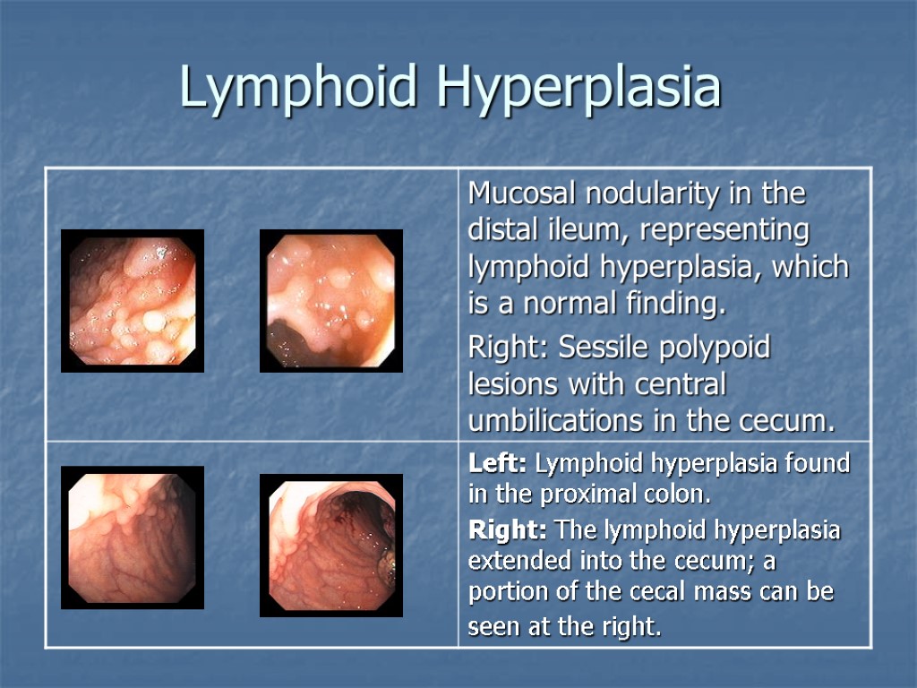 Lymphoid Hyperplasia